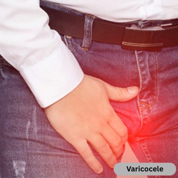 Varicocele
