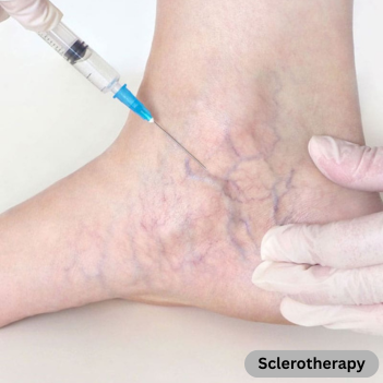 Sclerotherapy