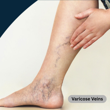 Varicose Veins